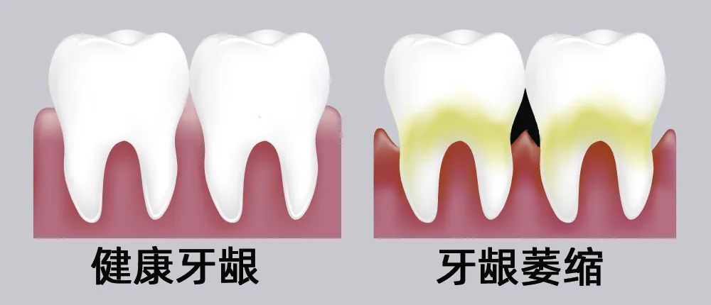 牙縫大露出“黑三角”，既塞牙又難看！還能恢復嗎？
